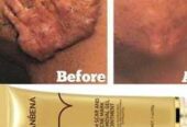 Lanbena scar remover gel